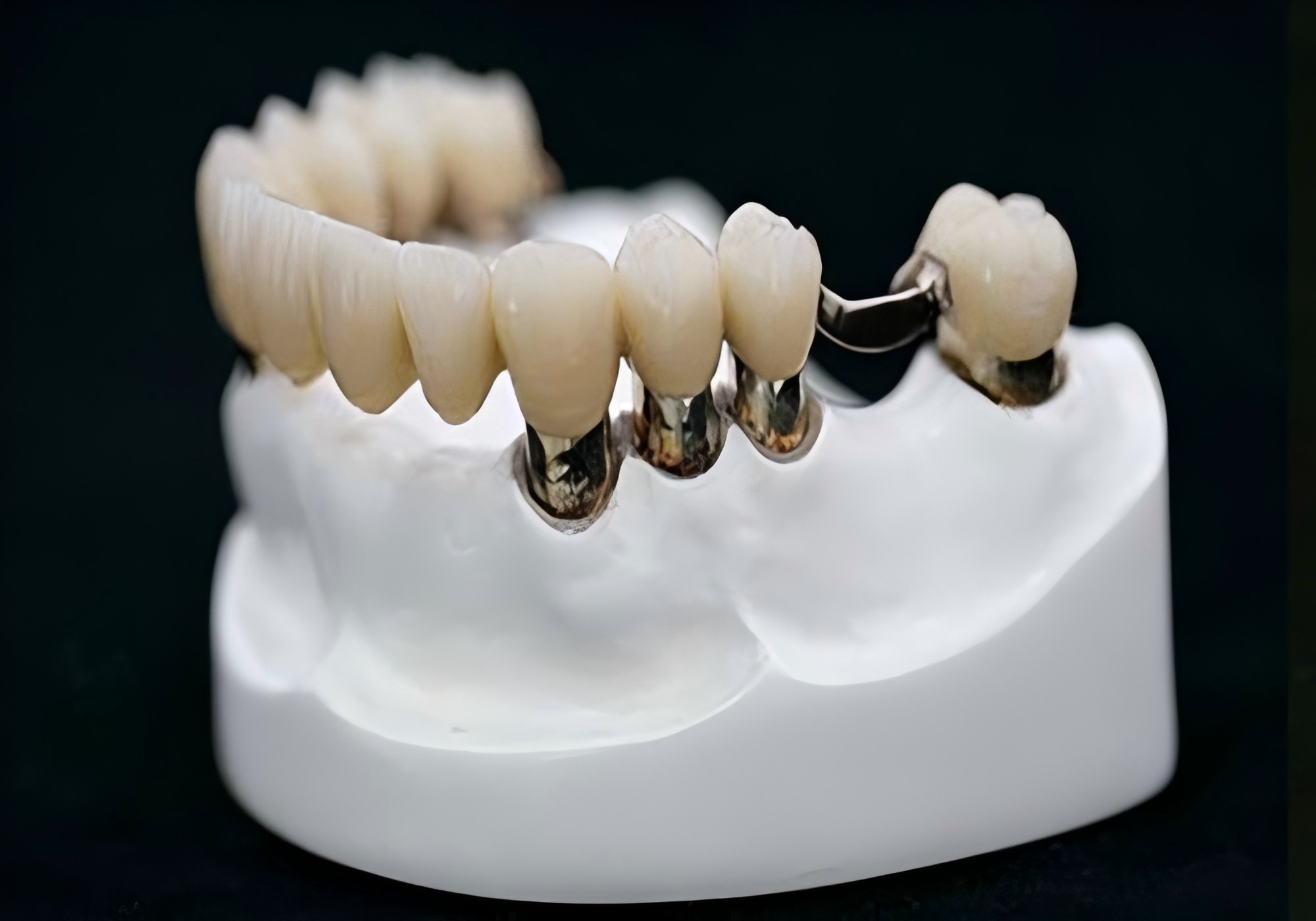 All Zirconia Screw-Retained Bridge