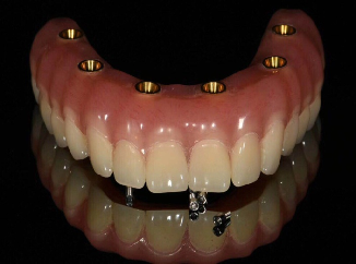 Implant